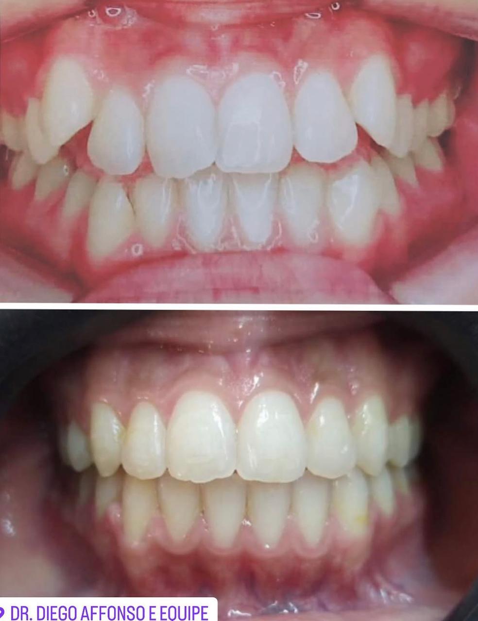 Caso real antes e depois — Dr. Diego Affonso