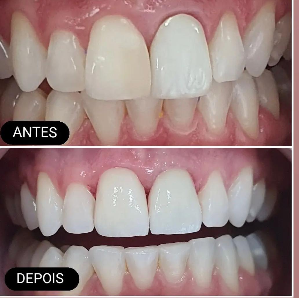 Caso real antes e depois — Dr. Diego Affonso