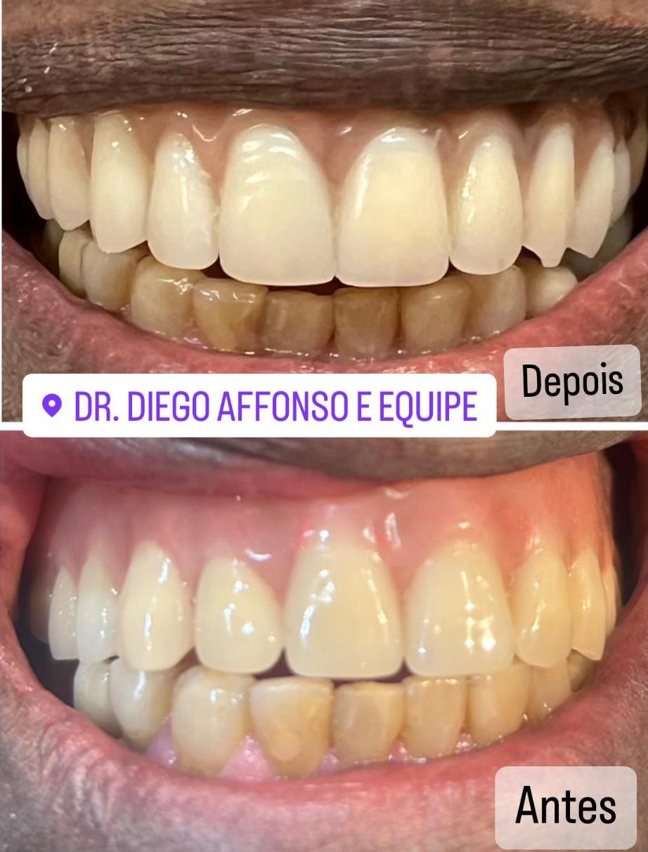 Caso real antes e depois — Dr. Diego Affonso