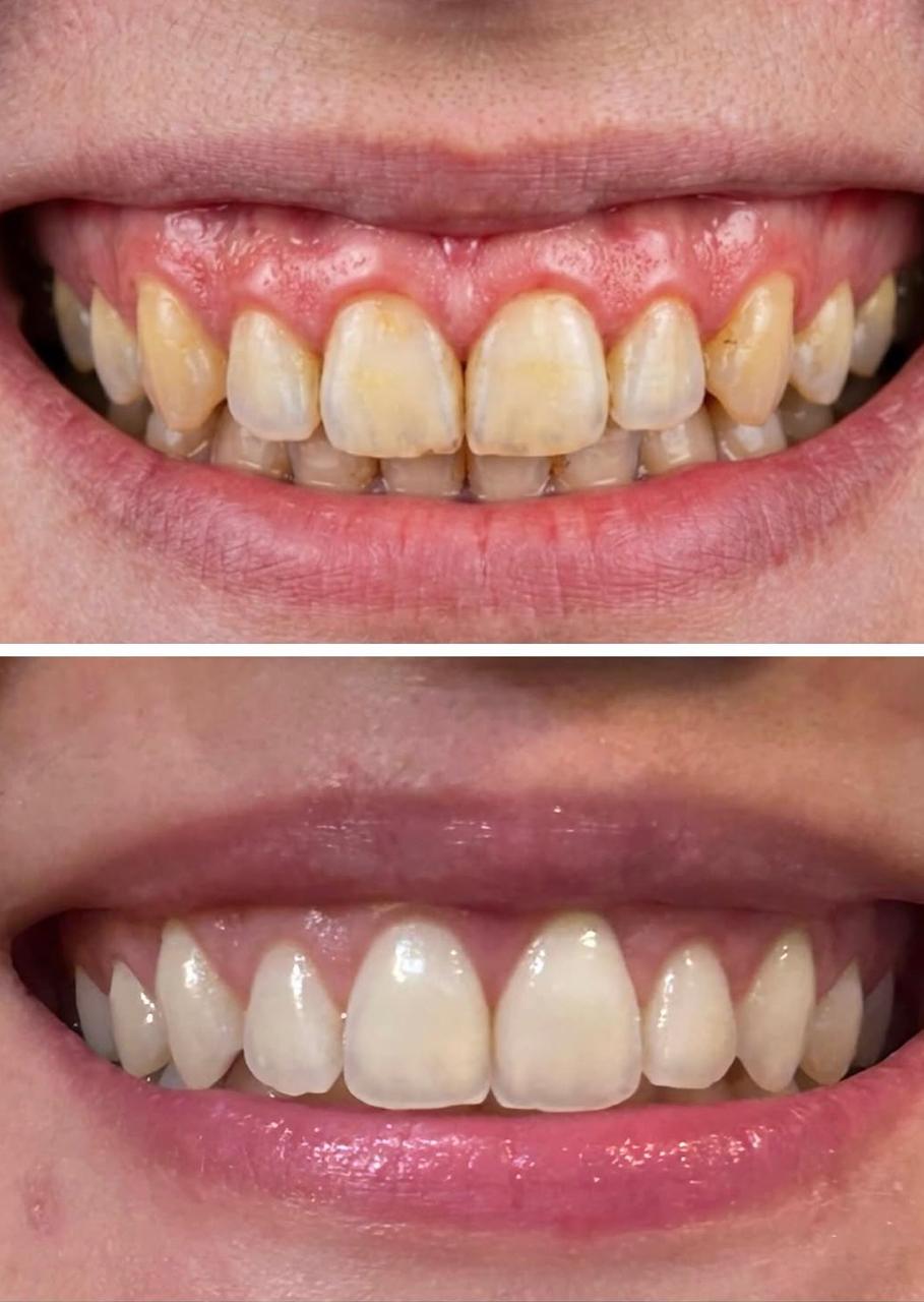 Caso real antes e depois — Dr. Diego Affonso