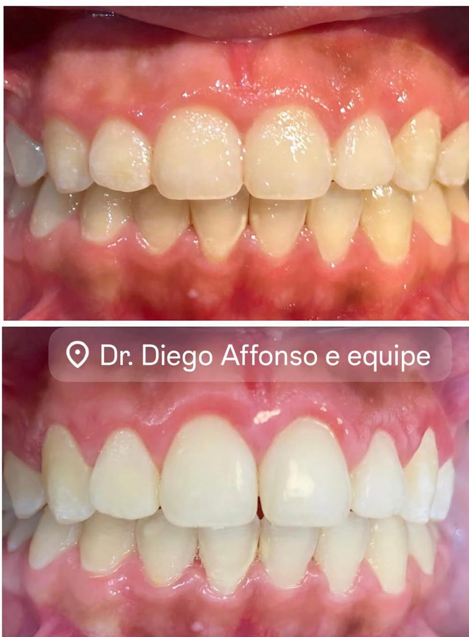 Caso real antes e depois — Dr. Diego Affonso