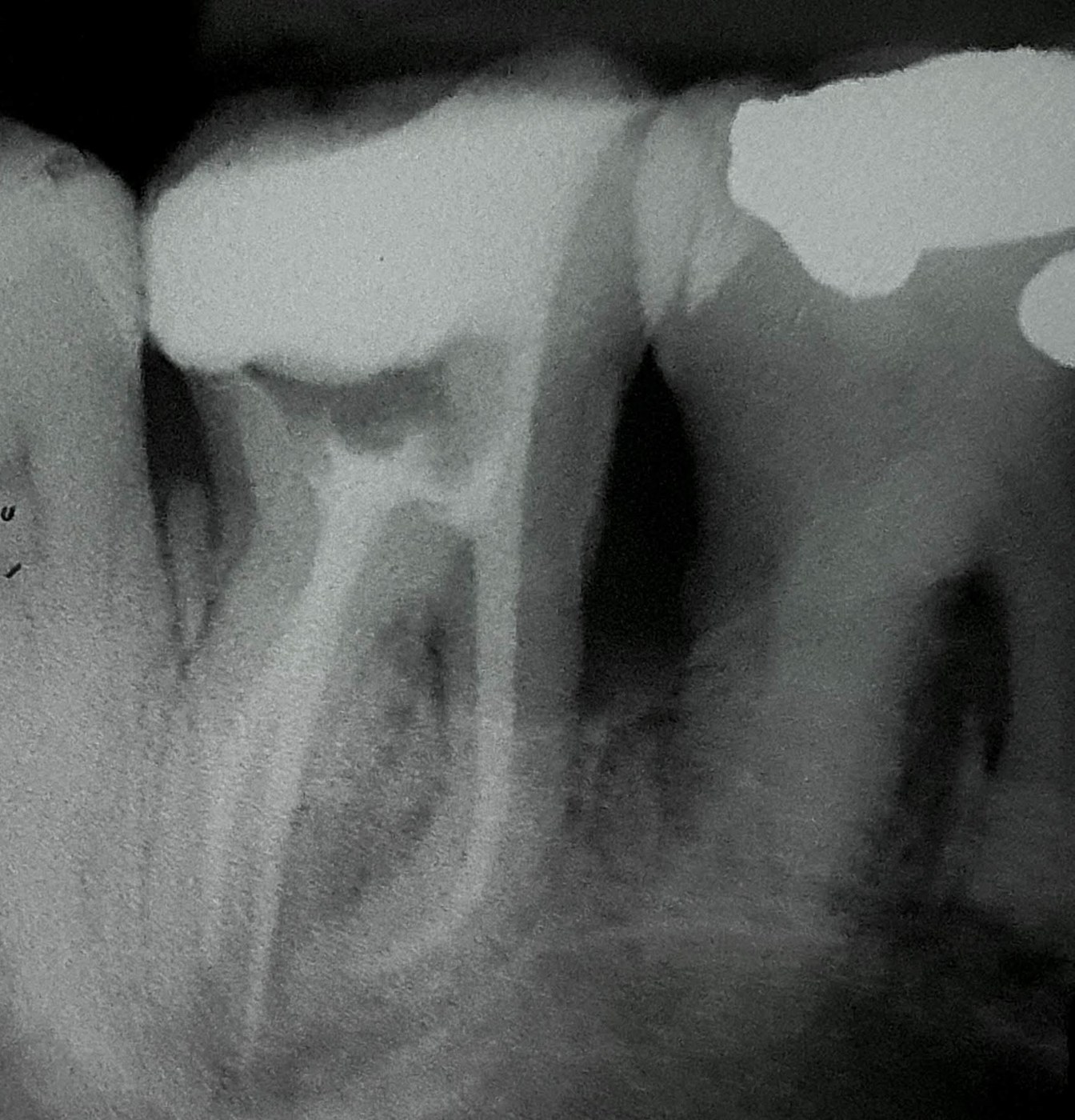 Radiografia de tratamento de canal concluído — Dr. Diego Figueiredo Affonso, CROSP 72.278, Itaquera–SP