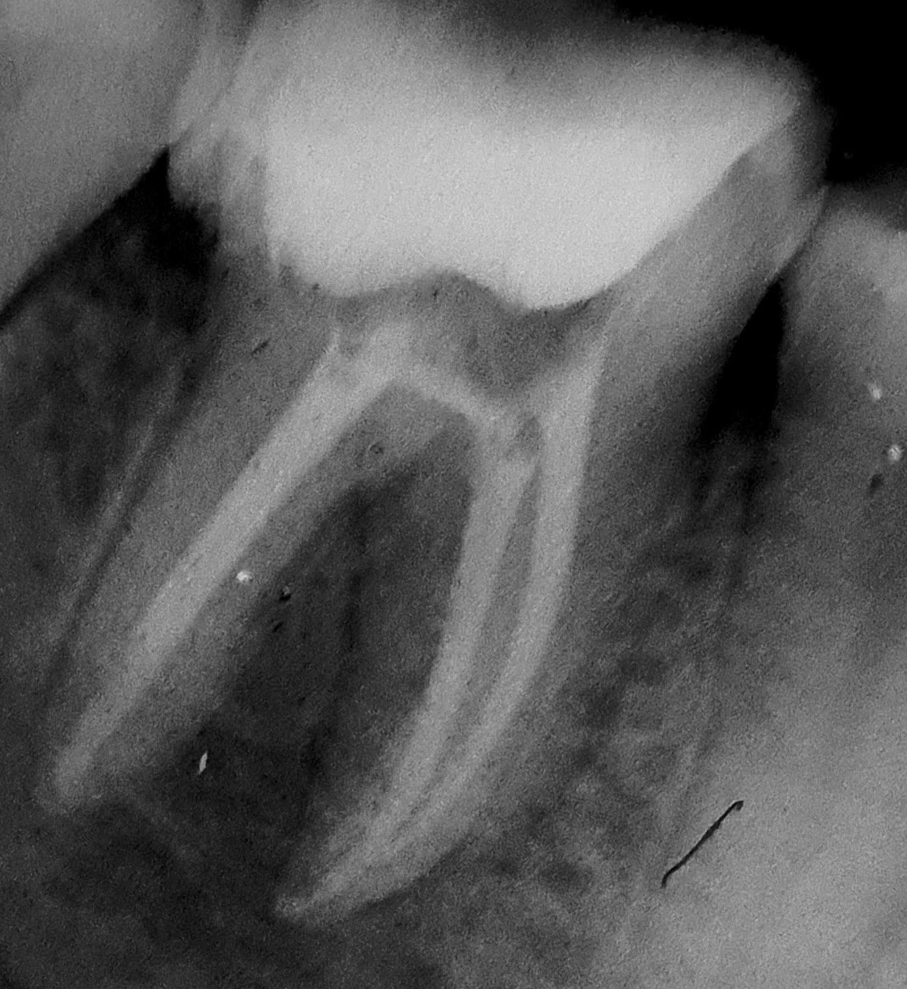 Radiografia de tratamento endodôntico — Dr. Diego Figueiredo Affonso, CROSP 72.278, Itaquera–SP